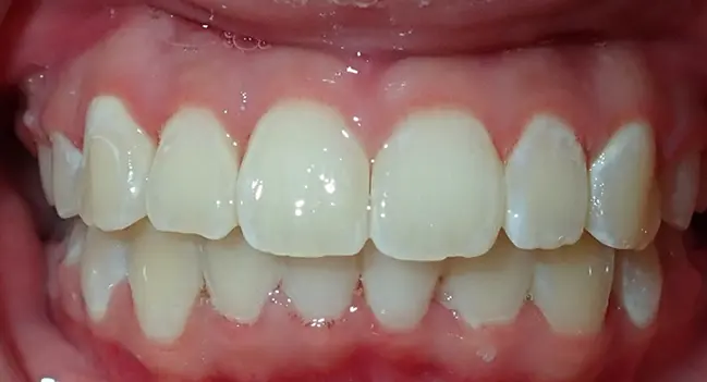 Sound Orthodontics - After Orthodontic Treatment