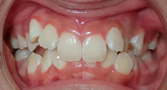 Sound Orthodontics - Before Orthodontic Treatment