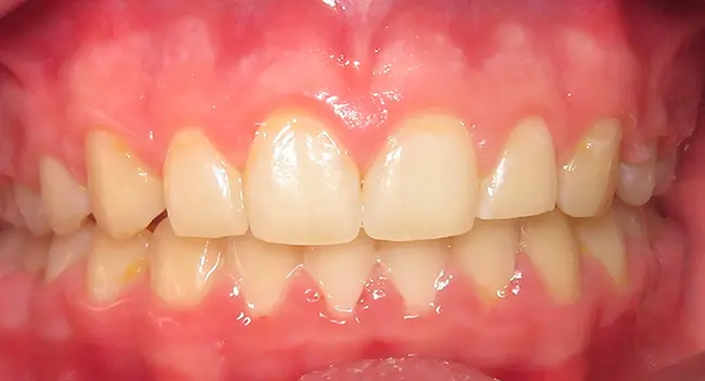 Sound Orthodontics - After Orthodontic Treatment