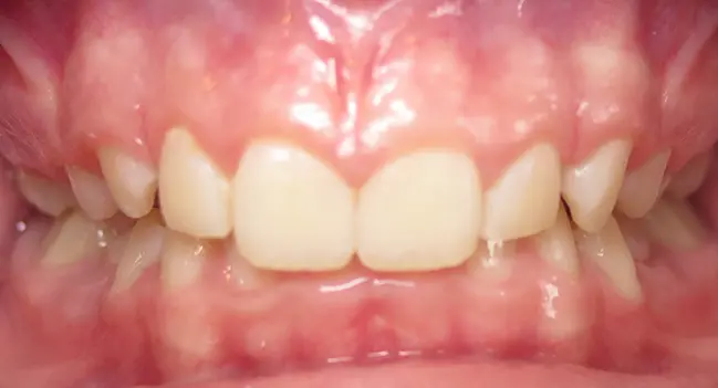 Sound Orthodontics - Before Orthodontic Treatment