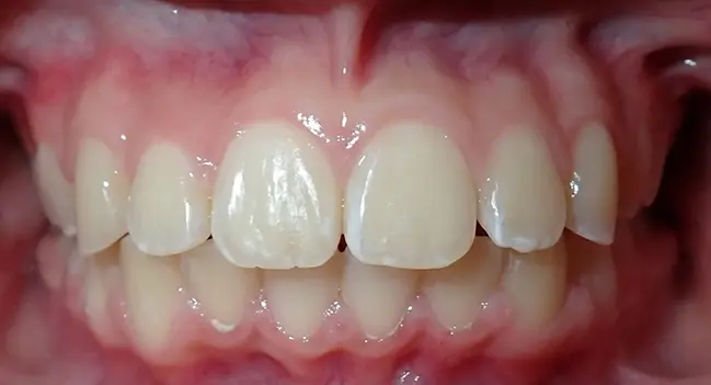 Sound Orthodontics - After Orthodontic Treatment