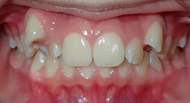 Sound Orthodontics - Before Orthodontic Treatment