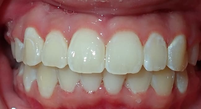 Sound Orthodontics - After Orthodontic Treatment