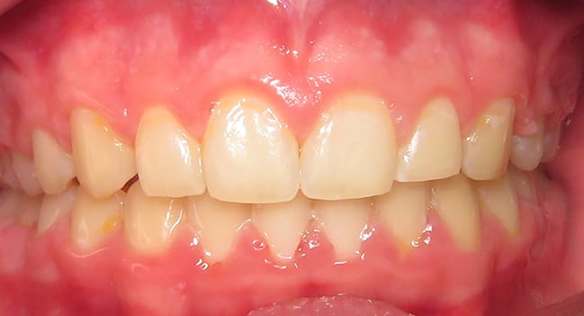 Sound Orthodontics - After Orthodontic Treatment