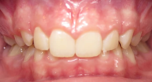 Sound Orthodontics - Before Orthodontic Treatment