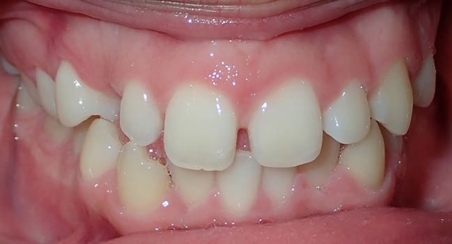 Sound Orthodontics - Before Orthodontic Treatment