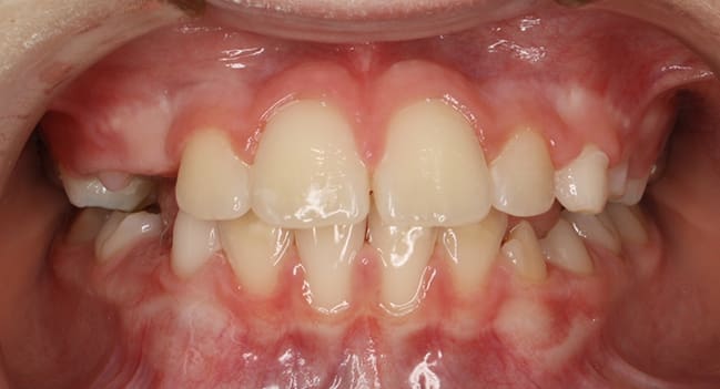 Sound Orthodontics - After Orthodontic Treatment