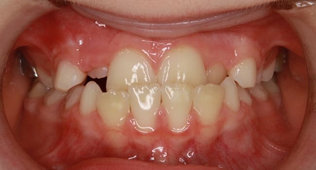 Sound Orthodontics - Before Orthodontic Treatment
